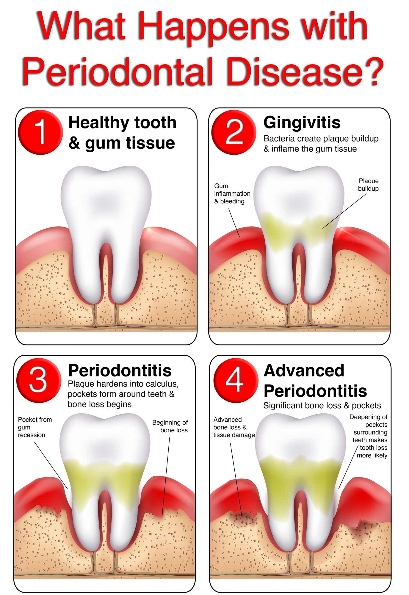 advanced periodontal disease